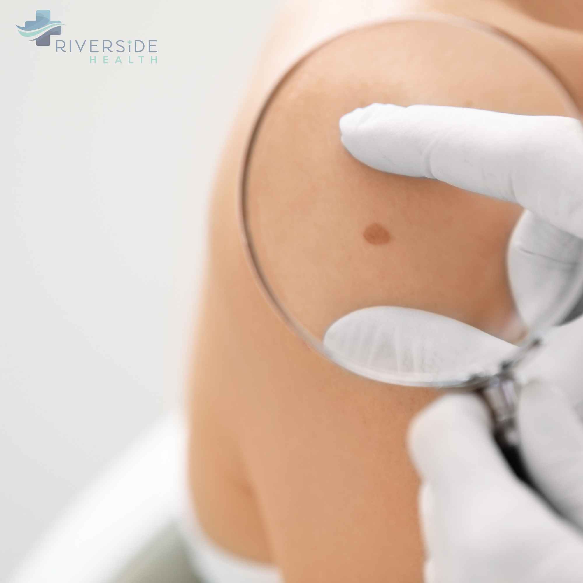 Skin cancer checks and management at Riverside Health Nedlands